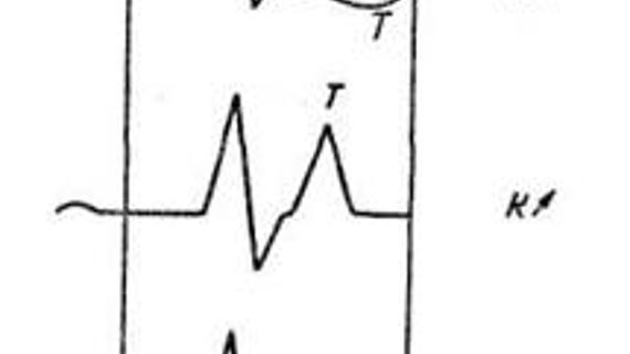 Превью картинка статьи Гиперкальциемия на экг — Про сосуды