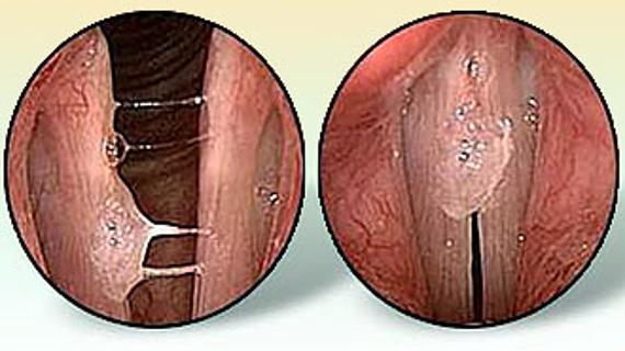 Превью картинка статьи Заболевания гортани – симптомы и лечение болезней 2022