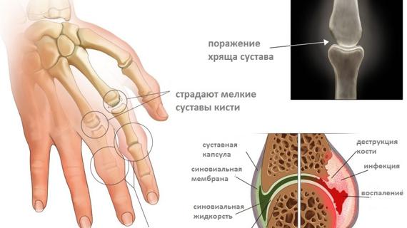 Превью картинка статьи Виды артритов кисти и их диагностика