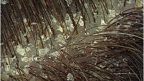 Превью картинка статьи Перхоть у ребенка 8 лет — Волосы