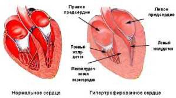 Превью картинка статьи Гипертрофия левого желудочка сердца что это и как можно лечить видео