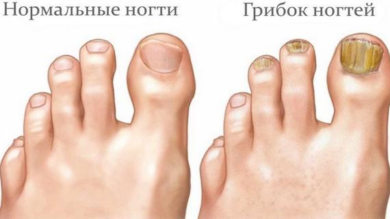 Превью картинка статьи Запах из под ногтей на ногах: каковы причины и как от него избавиться