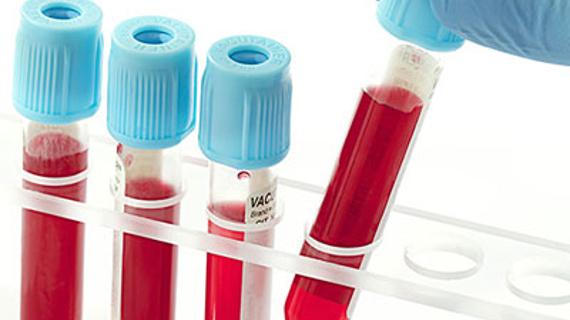 Превью картинка статьи Анализ крови при пневмонии у ребенка и взрослых: показатели, правила сдачи