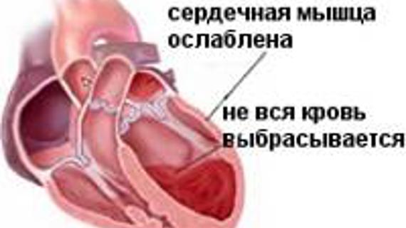 Превью картинка статьи Как определить сердечную недостаточность — Сердце