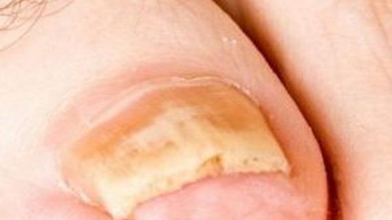 Превью картинка статьи Болит ноготь на ноге: причины и может ли болеть от грибка