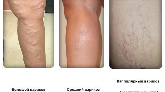 Превью картинка статьи Как и чем лечить сильный варикоз вен на ногах у женщин и мужчин без операции