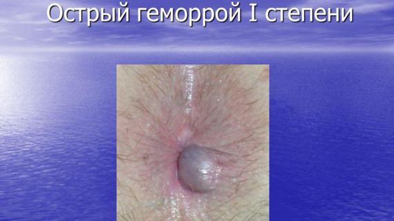 Превью картинка статьи Свечи и мази от геморроя: что лучше всего помогает от геморроя