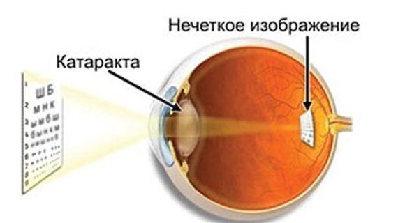 Превью картинка статьи Катаракта: причины, симптомы, лечение и профилактика