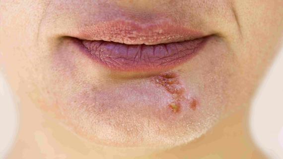 Превью картинка статьи Сыпь на лбу и вокруг рта