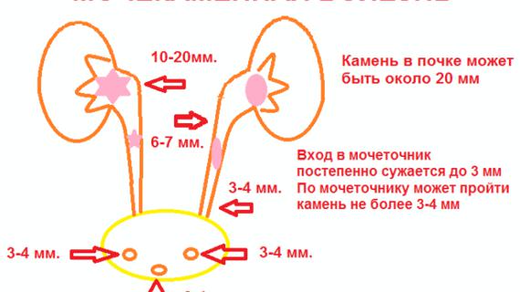 Превью картинка статьи Куда продать камни из почек