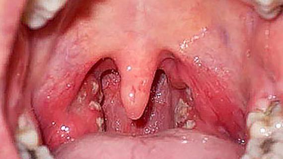 Превью картинка статьи Симптомы и признаки гнойной ангины у взрослых 2021