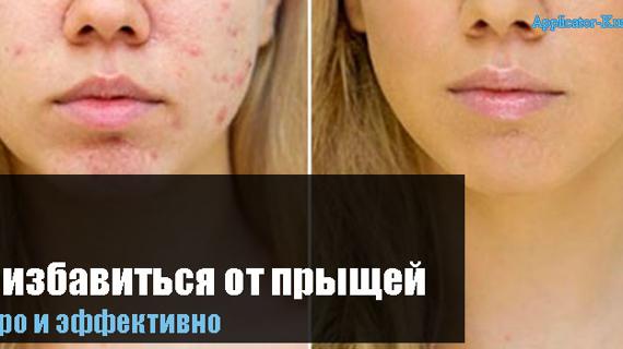 Превью картинка статьи Как избавиться от прыщей в домашних условиях быстро и эффективно подростку