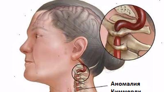 Синдром артерии шейный отдел