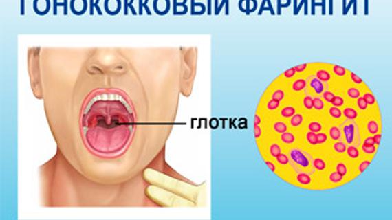 Превью картинка статьи Гонококковый (гонорейный) фарингит – симптомы и лечение 2021