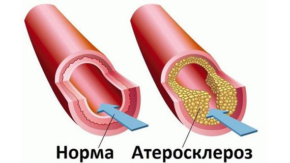 Превью картинка статьи Какой врач лечит атеросклероз