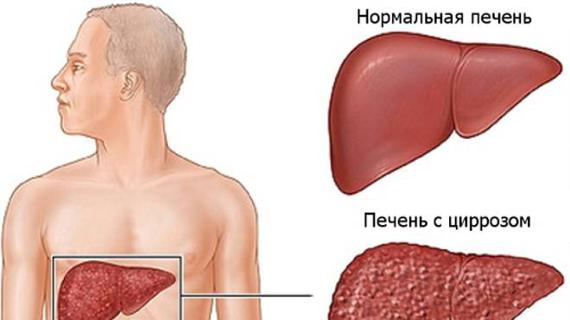 Превью картинка статьи Как умирают от цирроза печени — Все о печени