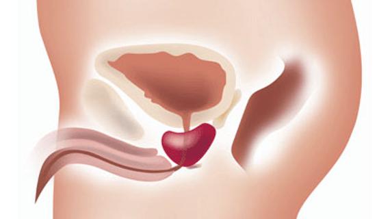 Превью картинка статьи Первая помощь при аденоме простаты