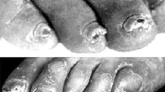 Превью картинка статьи Современные методы лечения больных микозами стоп