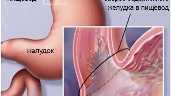 Превью картинка статьи Рефлюкс у грудных детей и новорожденных: симптомы, лечение