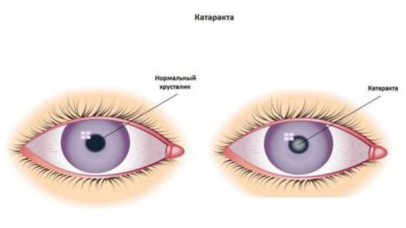Превью картинка статьи Глазные капли Катаксол: инструкция по применению, отзывы