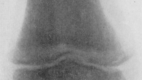 Превью картинка статьи Изменения в костях при остром лейкозе