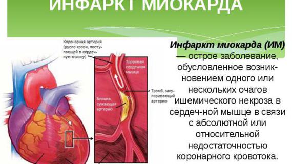 Превью картинка статьи Пока идут месячные инсульта и инфаркта не будет