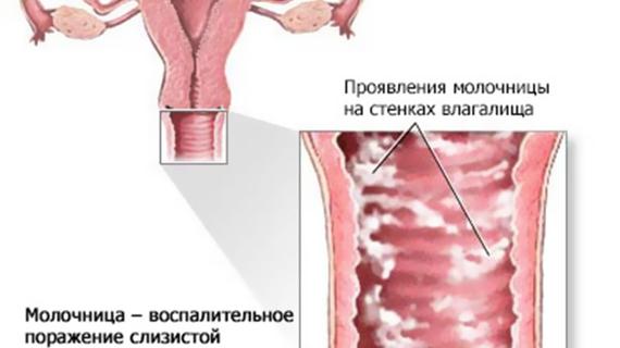 Превью картинка статьи Препараты от молочницы: недорогие и эффективные, ТОП 10