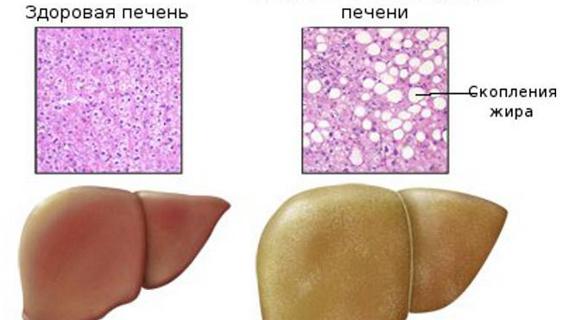Превью картинка статьи Жировые отложения в печени — Все о печени