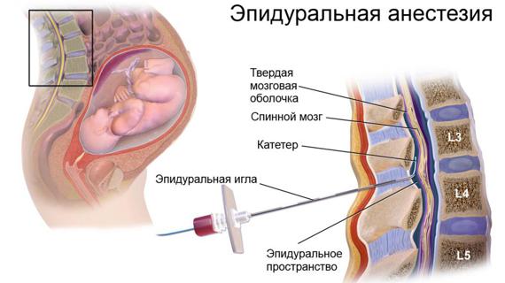 Превью картинка статьи Эпидуральная анестезия при родах: отзывы и последствия