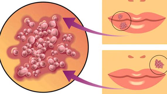 Превью картинка статьи Что такое цитомегаловирусная инфекция в гинекологии