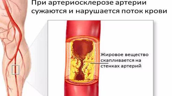 Превью картинка статьи Закупорка сосудов — Сердце