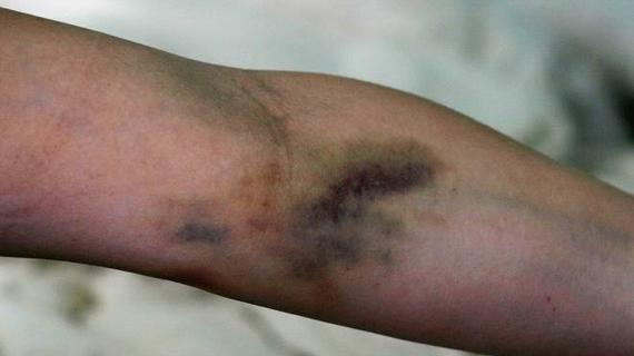 Превью картинка статьи Постинъекционный флебит — Сердце