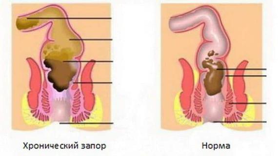 Превью картинка статьи Лактофильтрум при запорах: инструкция по применению и отзывы
