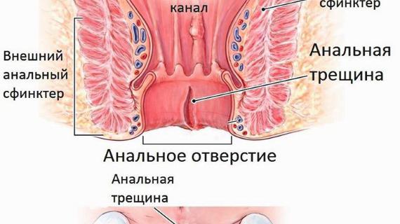 Превью картинка статьи Болезни ануса: список заболеваний прямой кишки и заднего прохода, фото симптомов