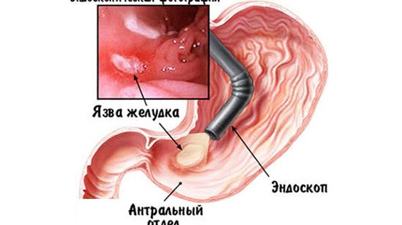 Превью картинка статьи Можно ли курить перед гастроскопией: как правильно подготовиться к ФГДС