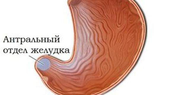 Превью картинка статьи Антральный гастрит: причины, симптомы, формы, диагностика, чем опасен
