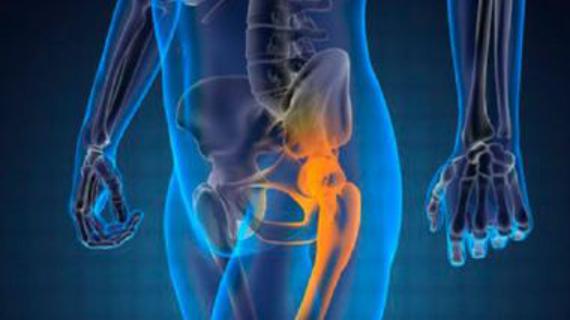 Превью картинка статьи Что такое экзостоз в вертлужной впадине