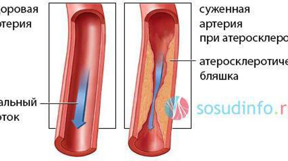 Спазм сосудов это