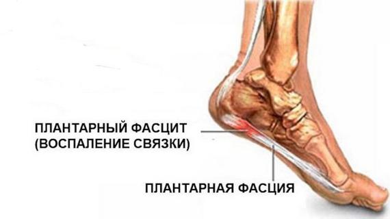 Превью картинка статьи Плантарный фасциит: причины, признаки и методы лечения