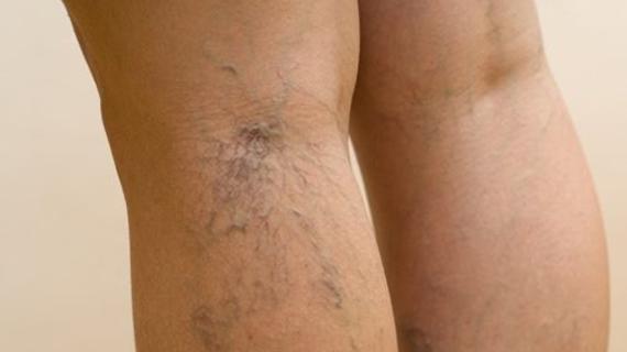 Превью картинка статьи Можно ли полностью вылечить варикоз? – Медицинский портал