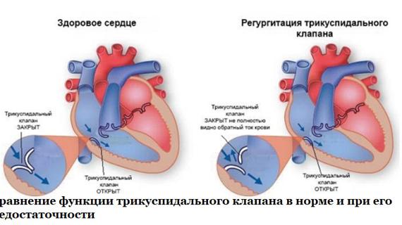 Превью картинка статьи Трикуспидальная недостаточность 1-й, 2-й и 3-й степеней: причины, симптомы и лечение