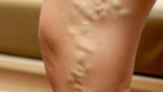 Превью картинка статьи Гирудотерапия при тромбозе глубоких вен нижних конечностей