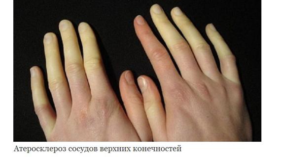 Превью картинка статьи Все об атеросклерозе верхних конечностей