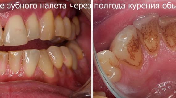 Превью картинка статьи Желтеют ли зубы от glo