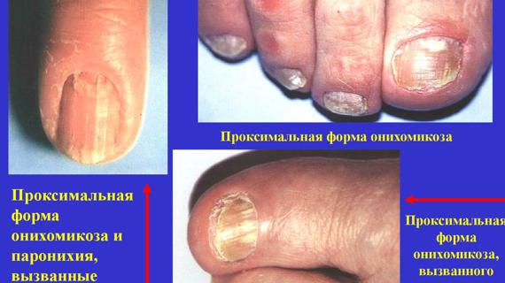 Превью картинка статьи Чем отличается онихолизис от онихомикоза