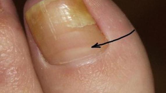 Превью картинка статьи Удаление ногтевой пластины: как проводится, можно ли сделать самому