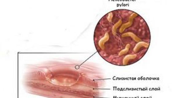 Превью картинка статьи Карцинома желудка: что это такое, как возникает, симптомы, лечение, прогноз