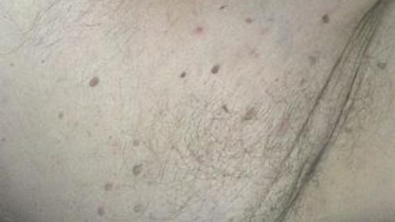 Превью картинка статьи Кондиломы в паху