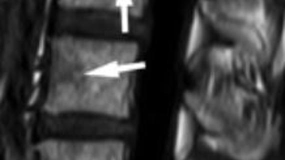 Превью картинка статьи Может ли мрт определить остеопороз