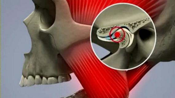 Превью картинка статьи Остеопороз костей черепа: челюсти, спинки турецкого седла